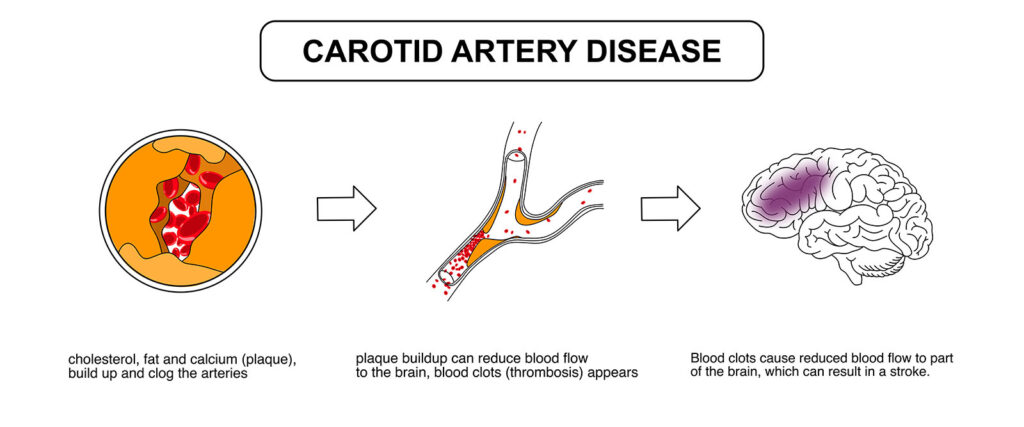 Ilustrasi penyakit arteri karotis yang menunjukkan penumpukan plak yang menghambat aliran darah ke otak dan meningkatkan risiko stroke.
