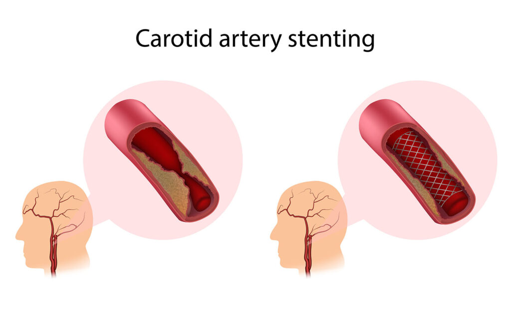 Diagram pemasangan stent arteri karotis untuk membuka pembuluh darah yang menyempit dan melancarkan aliran darah ke otak.