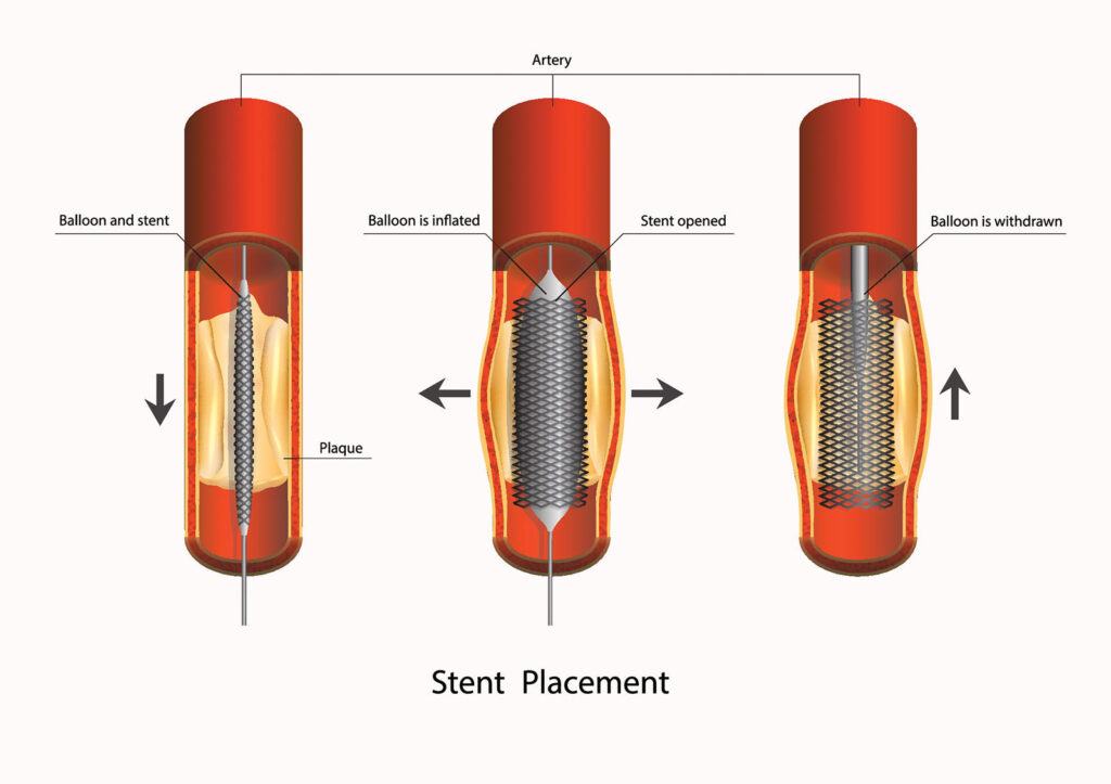 Diagram angioplasti dan pemasangan stent yang menunjukkan balon mengembang di dalam pembuluh darah yang menyempit untuk membukanya dan melancarkan aliran darah.