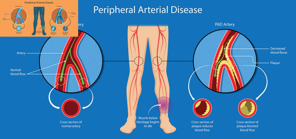 Ilustrasi penyakit arteri perifer yang menunjukkan penumpukan plak pada pembuluh darah kaki sehingga mengurangi aliran darah dan menyebabkan nyeri pada kaki.