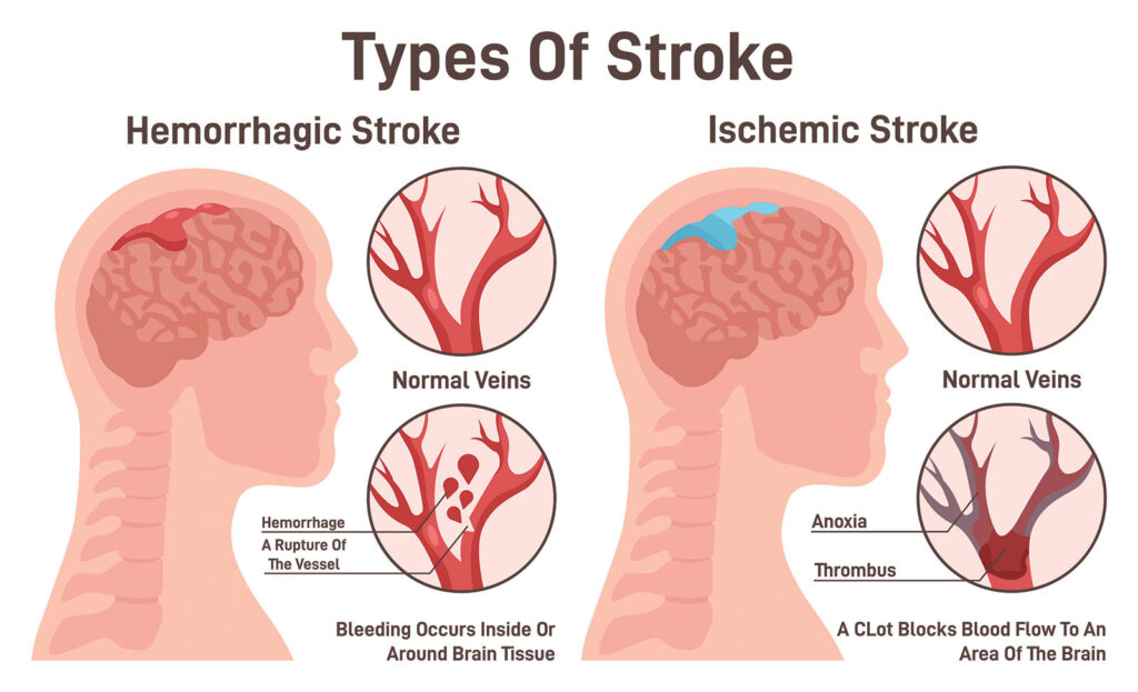 Ilustrasi perbandingan stroke hemoragik dan stroke iskemik yang menunjukkan perdarahan di otak dibandingkan dengan penyumbatan aliran darah.