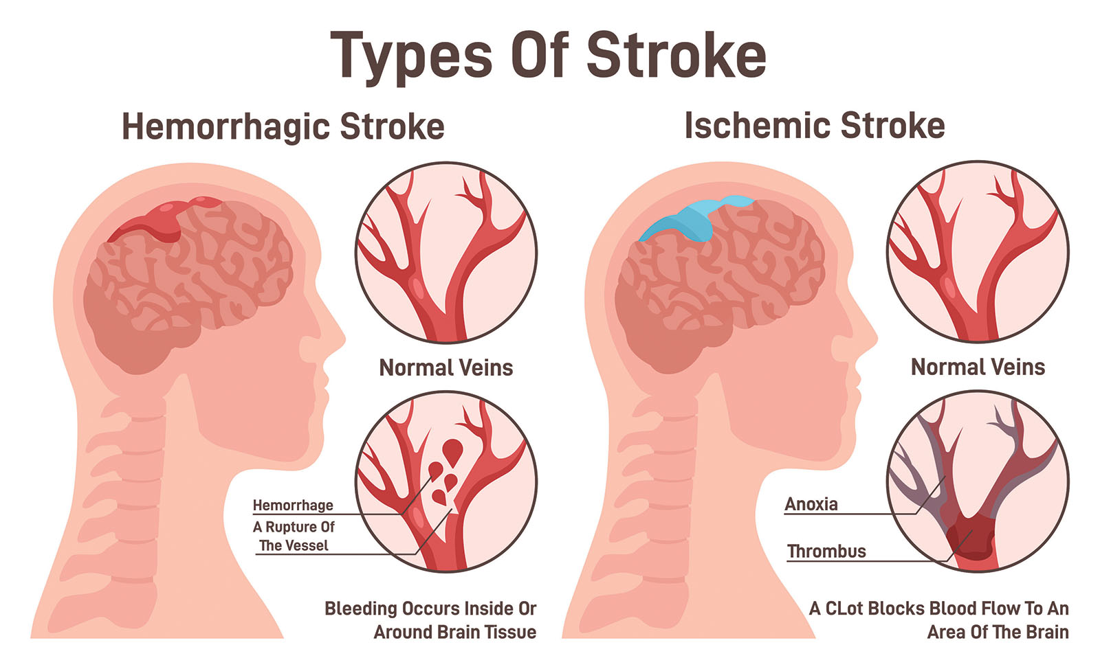 High Compression Stroke Stroke Treatment in Singapore: Thrombectomy & Stenting for Faster Recovery